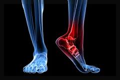 التهاب فاشیای کف پا یا خار پاشنه